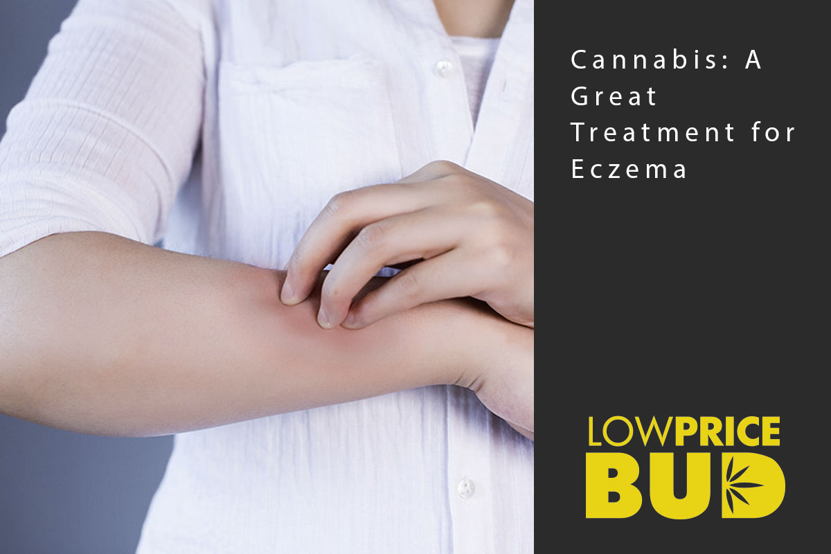 eczema
